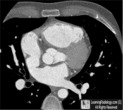 atrial septal defect Sinus Venosus